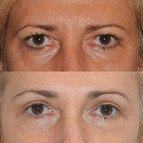 Real patient Eyelid & Brow Gallery