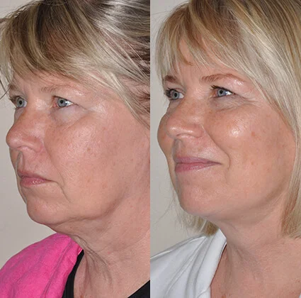 Real patient Face & Neck Lift Gallery