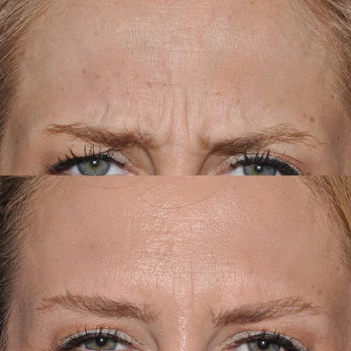 Real patient Injectable Rejuvenation Gallery