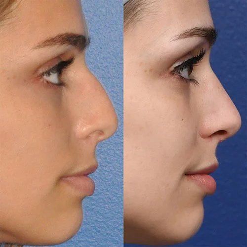 Real patient Rhinoplasty Gallery