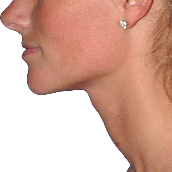 Real patient Kybella results