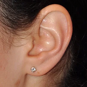 Real patient Otoplasty Ear Reshaping procedure Seattle
