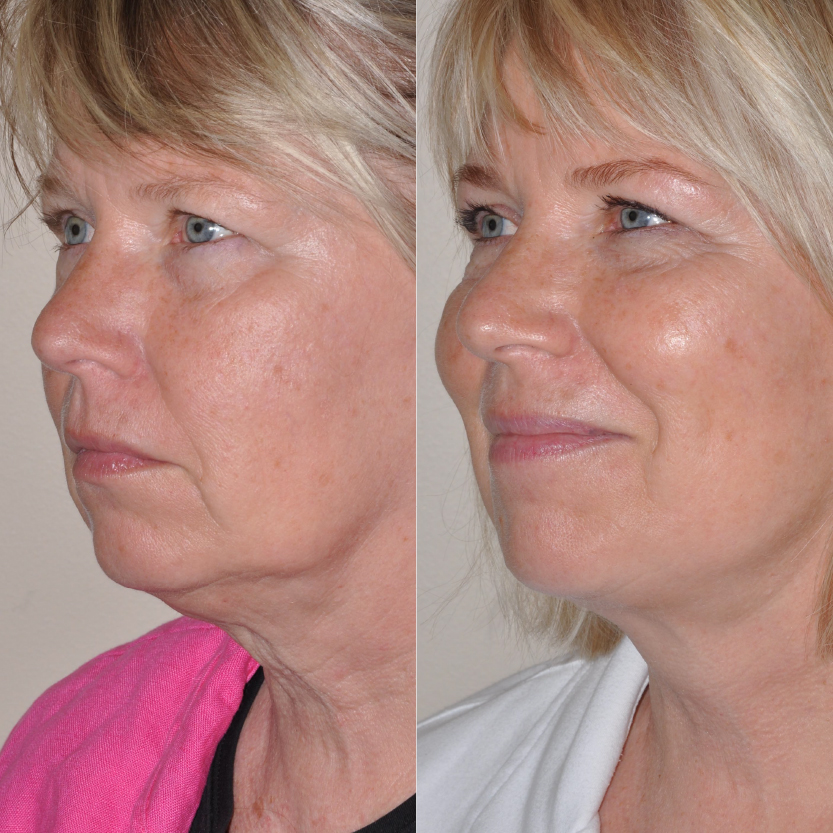 Face and Neck Lift Gallery