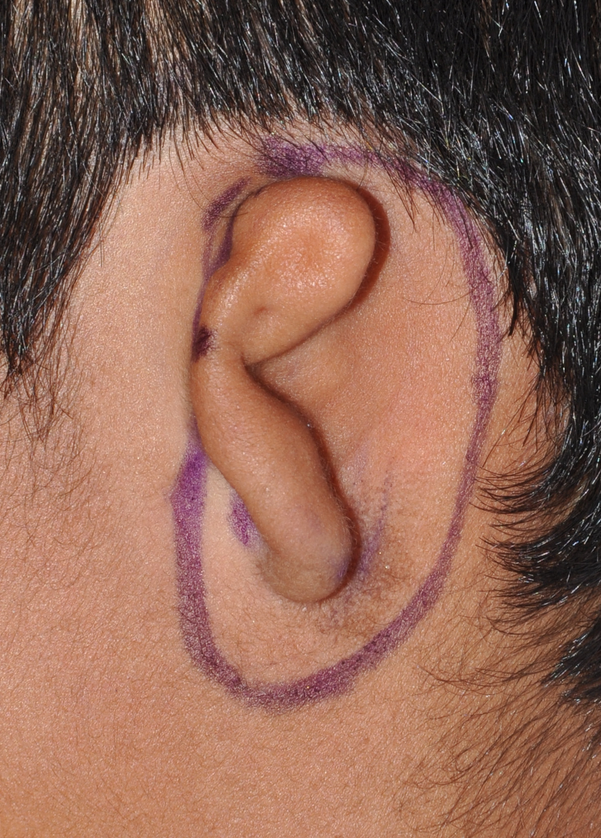 Microtia Reconstruction Gallery