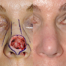 Nose Reconstruction Gallery