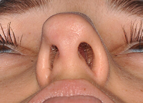 Rhinoplasty