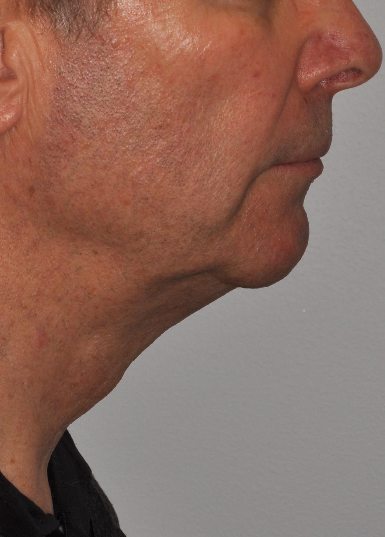 Face & Neck Lift