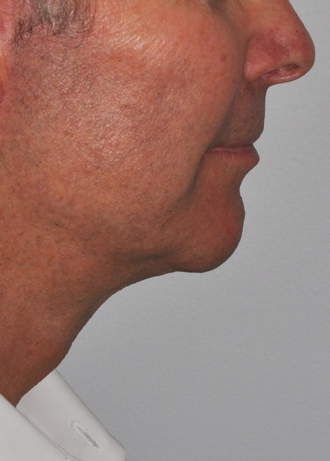 Face & Neck Lift