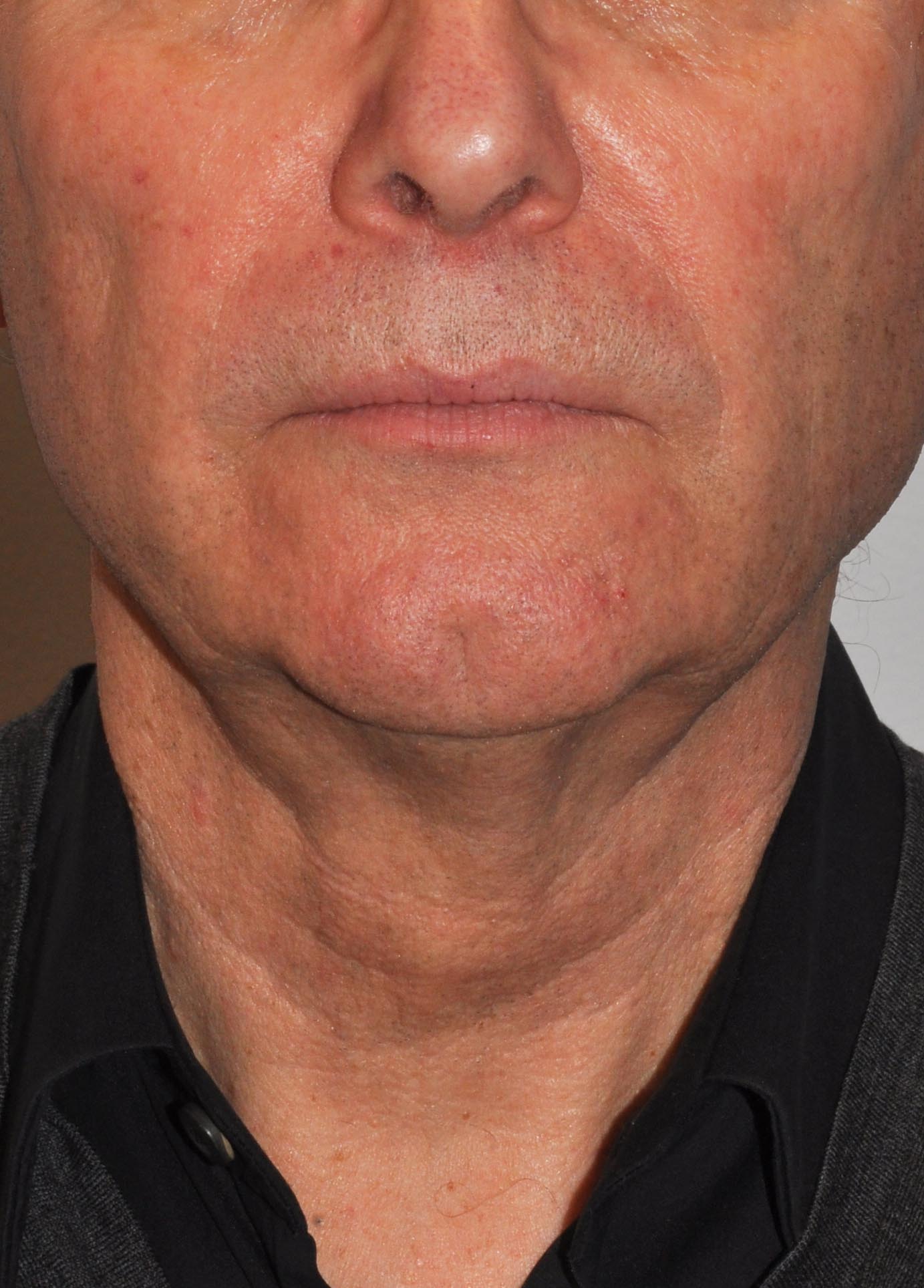 Face & Neck Lift