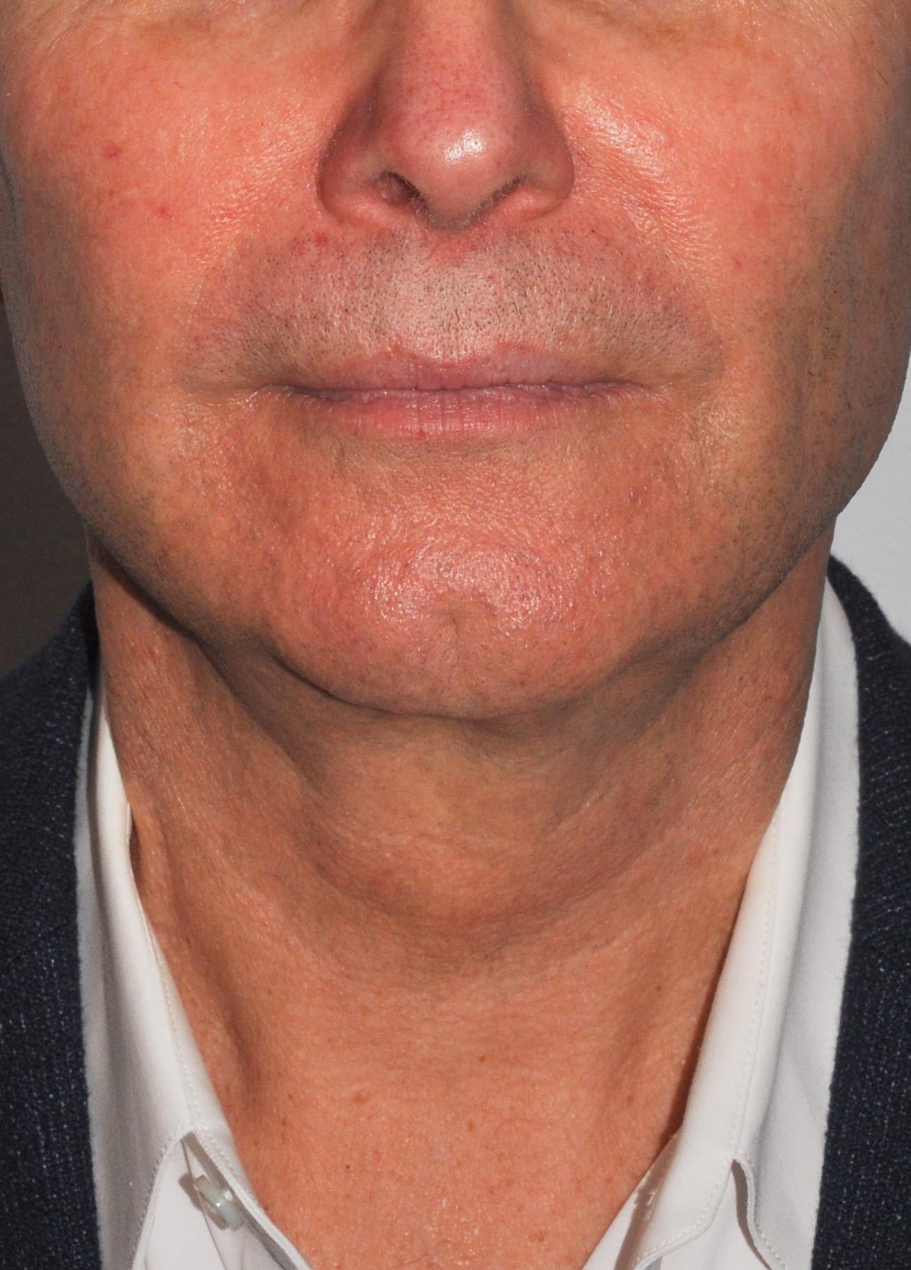 Face & Neck Lift