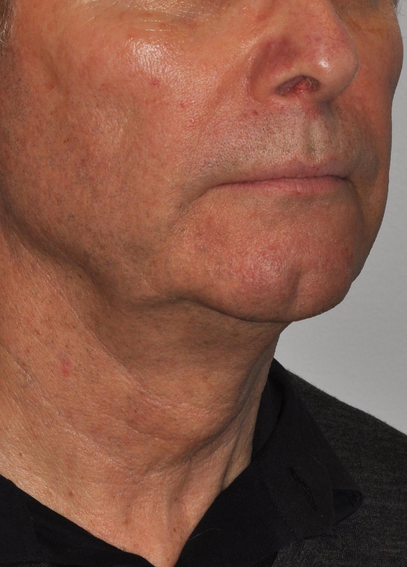 Face & Neck Lift