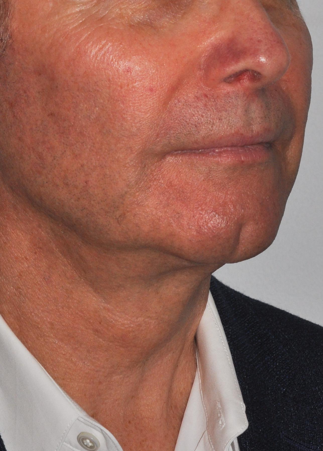 Face & Neck Lift