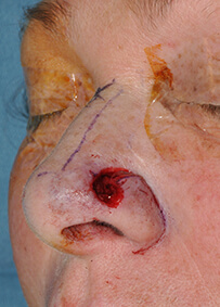 Nose Reconstruction