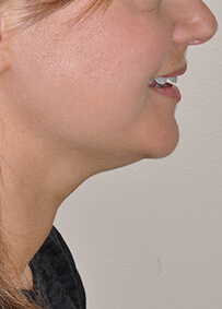 Face & Neck Lift