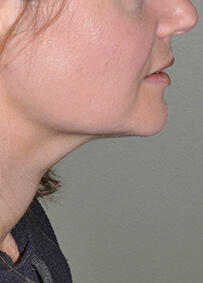 Face & Neck Lift