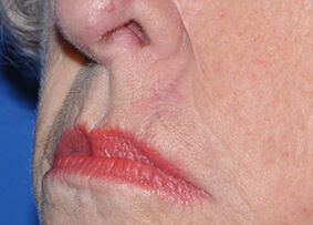 Lip Reconstruction