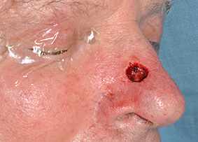 Nose Reconstruction
