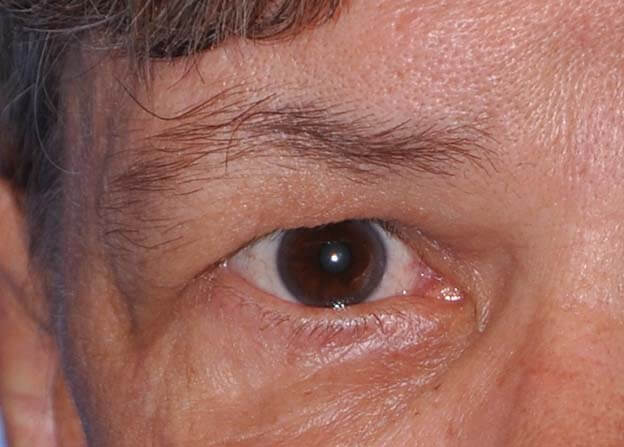 Blepharoplasty (Eyelid Lift)