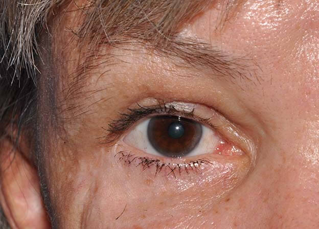 Blepharoplasty (Eyelid Lift)