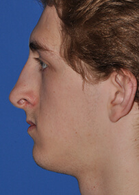 Rhinoplasty