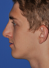 Rhinoplasty