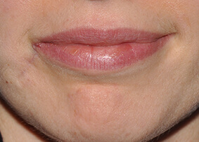Lip Reconstruction