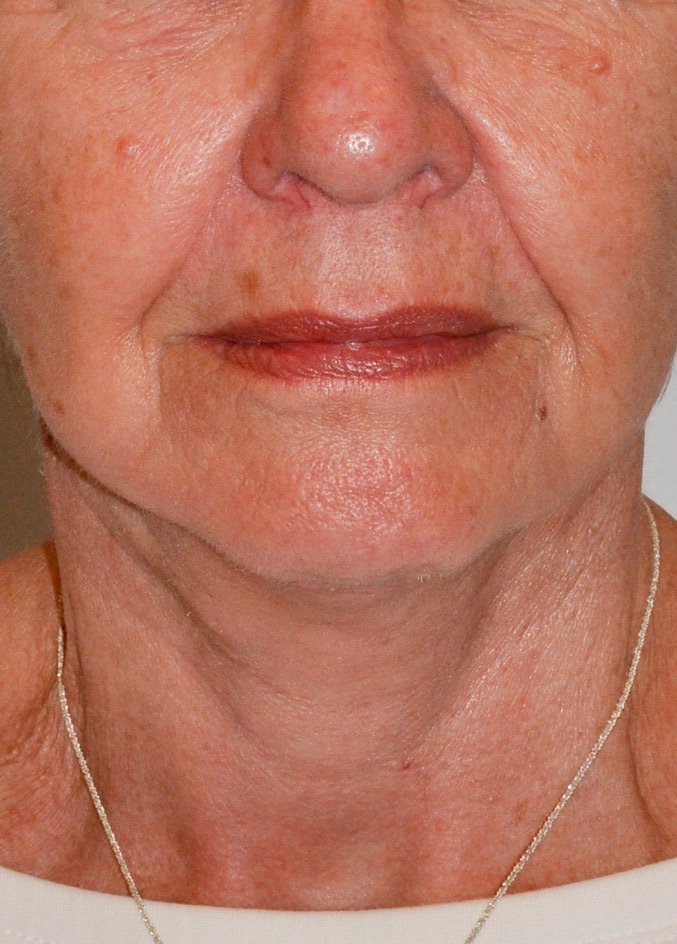 Face & Neck Lift