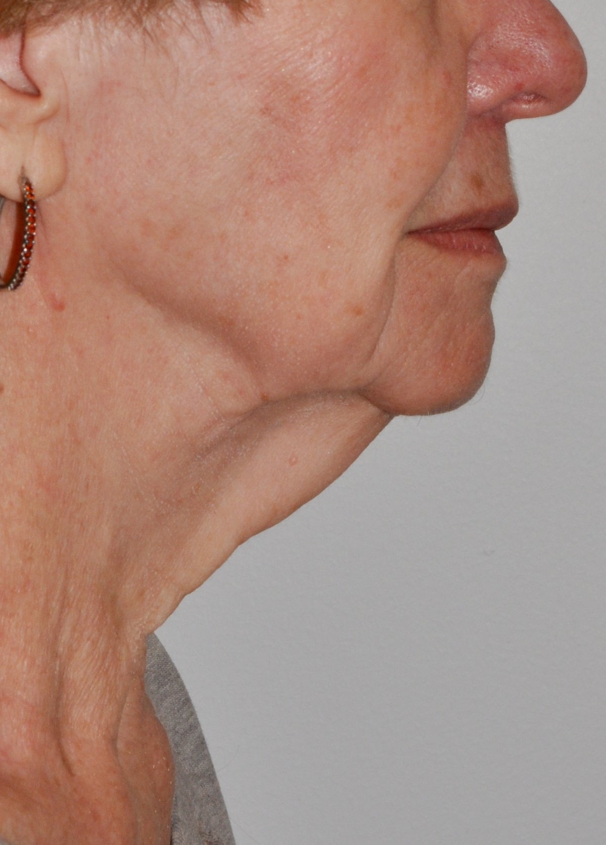 Face & Neck Lift