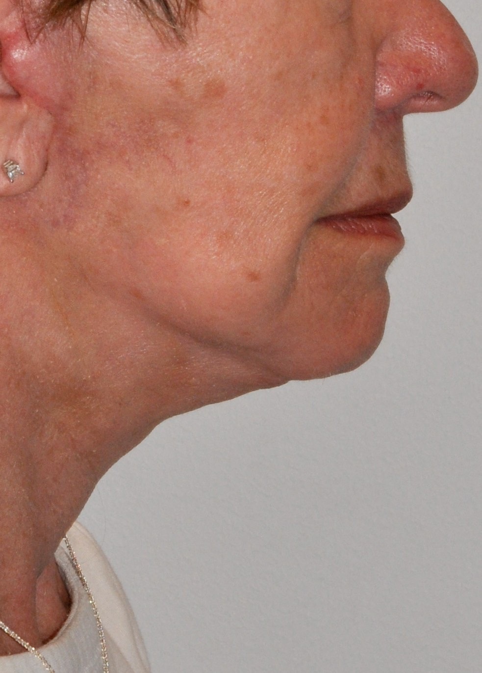 Face & Neck Lift