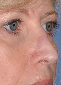 Nose Reconstruction