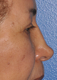 Revision Rhinoplasty