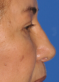 Revision Rhinoplasty