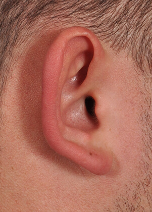 Otoplasty (Ear Reshaping)