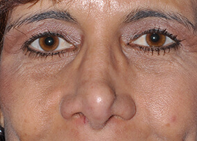 Revision Rhinoplasty