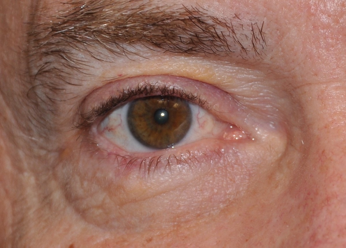 Eyelid & Cheek Reconstruction