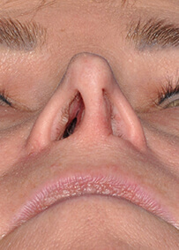 Revision Rhinoplasty