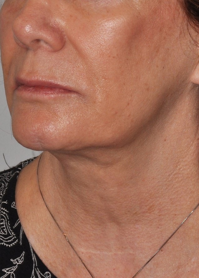 Face & Neck Lift