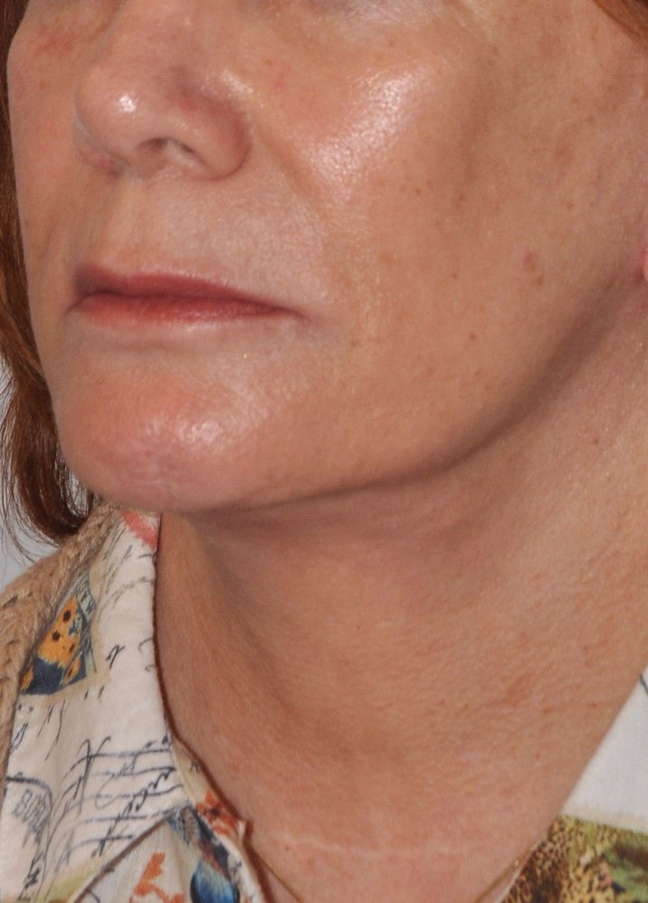 Face & Neck Lift