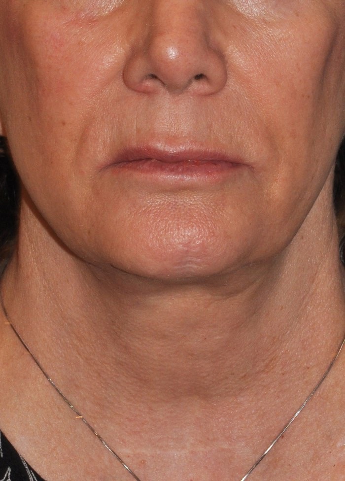 Face & Neck Lift