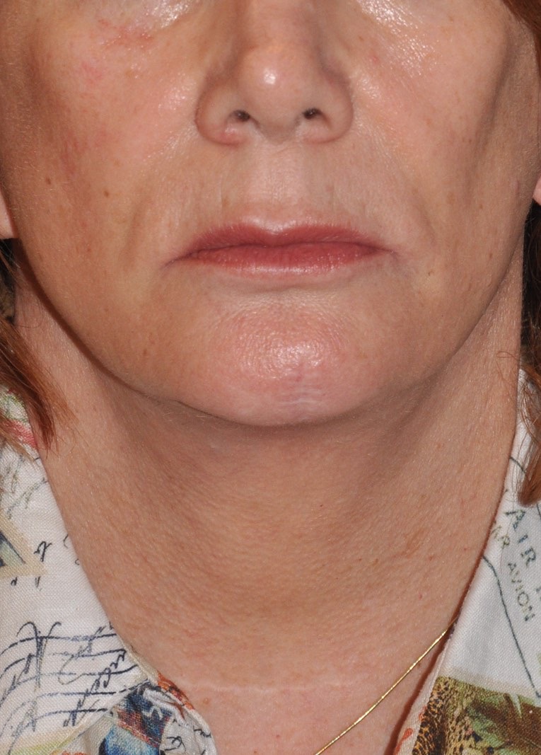 Face & Neck Lift