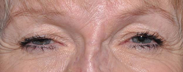 Blepharoplasty (Eyelid Lift)