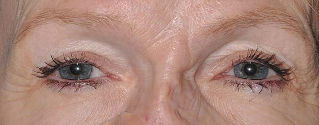 Blepharoplasty (Eyelid Lift)