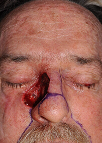 Nose Reconstruction