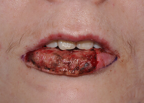 Lip Reconstruction