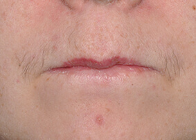 Lip Reconstruction