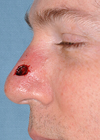 Nose Reconstruction