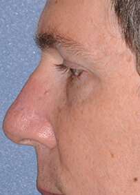 Nose Reconstruction