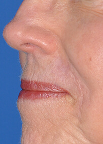 Lip Reconstruction