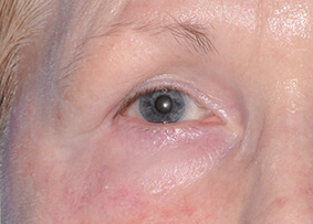 Eyelid & Cheek Reconstruction