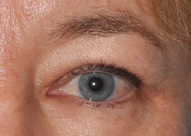 Blepharoplasty (Eyelid Lift)